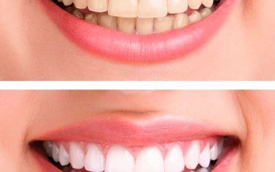 Recomendaciones para el blanqueamiento dental